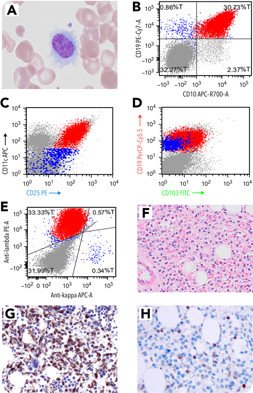 BloodPortfolio's tweet photo. Blood Work: Annexin A1− but CD10+ hairy cell leukemia https://t.co/D7LXEKCEng https://t.co/gSIxeRkex4