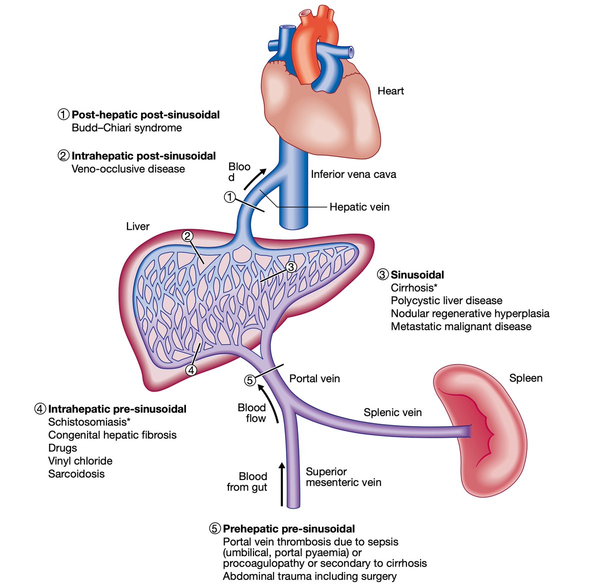Classification of portal hypertension by site #4KMedEd #LiverTwitter

(Courtesy of Davidson's)
