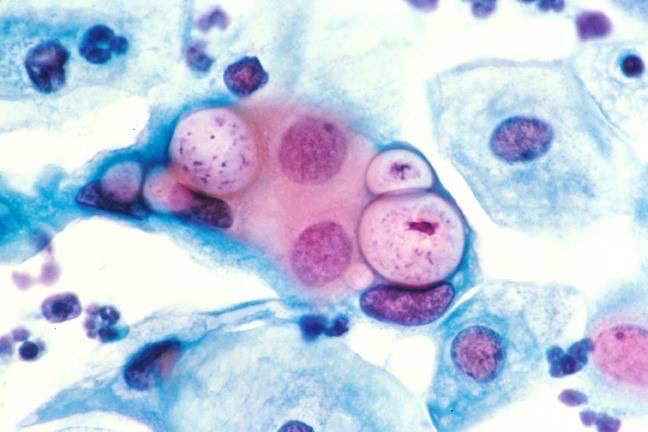 amigaRUTH's tweet photo. A beautiful clamydia pic! #Cytology #gynpath #Tweetpath #Cytopath https://t.co/2P4niCJhPi
