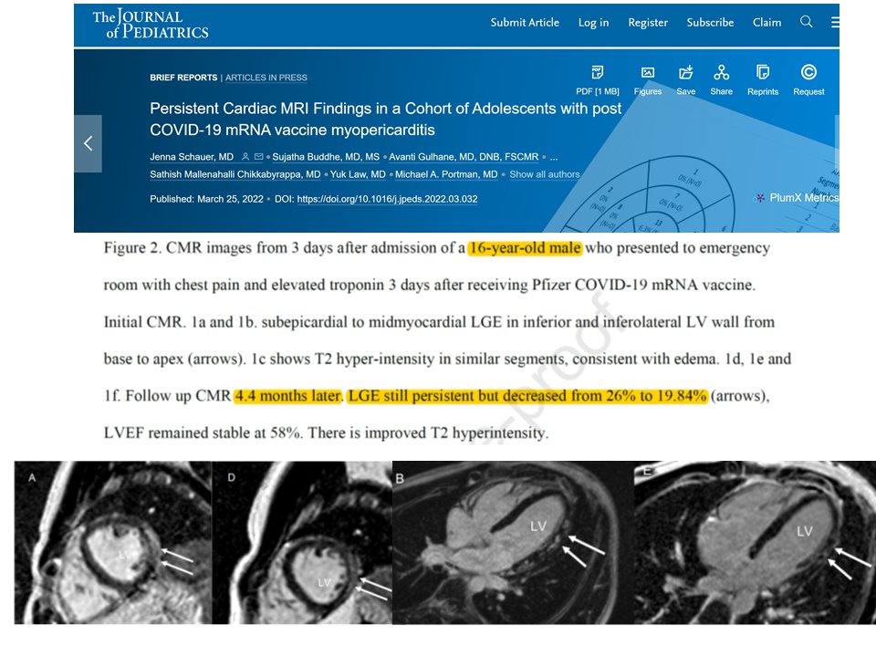 Schauer et al, Journal of Pediatrics, confirming cardiologists' worst fears for young boys/men with VI-myocarditis.  Heart damage (LGE) is still present at over 4 months since taking the ill-advised products.  Likely will lead to scar and risks for future cardiomyopathy, VT, VF