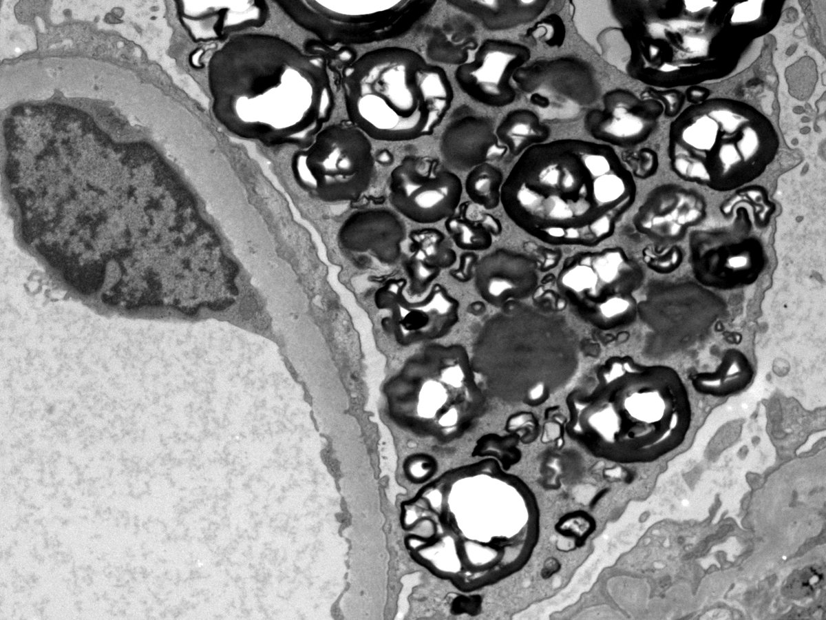 grace_choung's tweet photo. Middle-aged woman with fever, chills, pain in extremities, TIA-like sx, &amp; +anti-MPO. Bx'ed for presumed vasculitis, but found this instead:
Vacuolated podocytes which contain myeloid or "zebra bodies" by EM
Led to genetic testing confirming fabry disease in pt &amp; family.#renalpath https://t.co/tGHOZDOcne