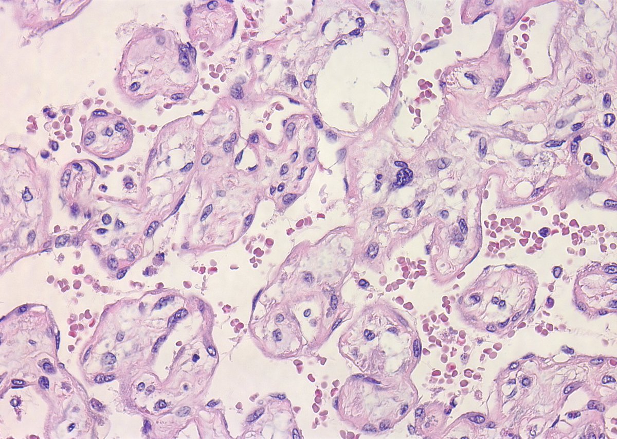 75 y/old, retroperitoneal lesion,H&E,would you like to propose any IHC to support the final diagnosis? @FionaMacPath @Cristina_VargAP @TristanRutland7 @CarlosMonteag20 @CleoRomagosa @proyectoimperas @HENRYY_MD @SumantaDas_7 @kells108 @PatolegsLaFe @PatologiaH12O @vallhebronpath