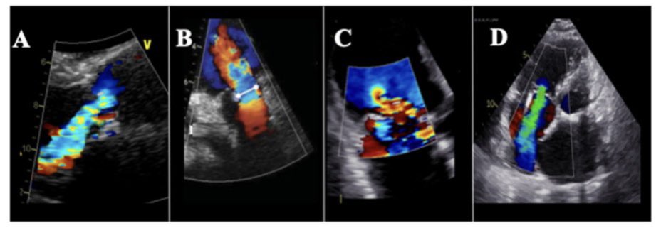 italian_cot's tweet image. 🫀💡Practically, the evaluation of valvular regurgitation requires the use of different imaging modalities 📷🧠

#cardiology #multimodalityimaging.  #cardioimaging #cardiologyfellow #cardiologia #echocardiography #ECG #cardiovascular #electrocardiography #cardiac #ITcardiology