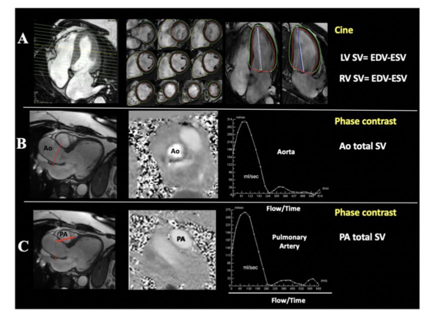 italian_cot's tweet image. 🫀💡Practically, the evaluation of valvular regurgitation requires the use of different imaging modalities 📷🧠

#cardiology #multimodalityimaging.  #cardioimaging #cardiologyfellow #cardiologia #echocardiography #ECG #cardiovascular #electrocardiography #cardiac #ITcardiology
