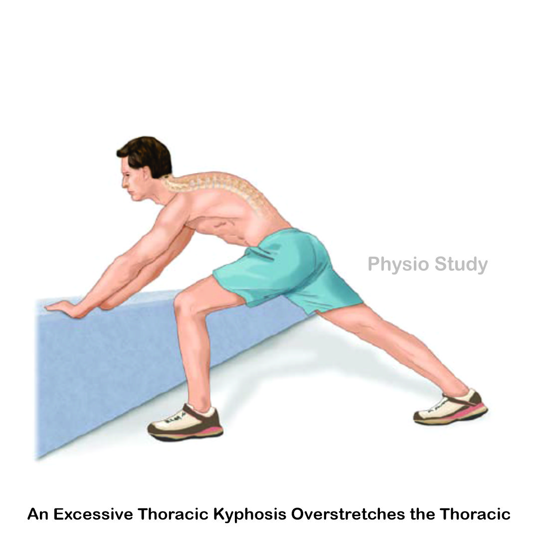 study_physio's tweet photo. Bending stresses are the most damaging to the spine because the upper part of the bent area loses it base of support.

When the spinal ligaments become too weak to hold the vertebrae together, the muscles have to work harder to provide support. https://t.co/ekfAhz5YxZ