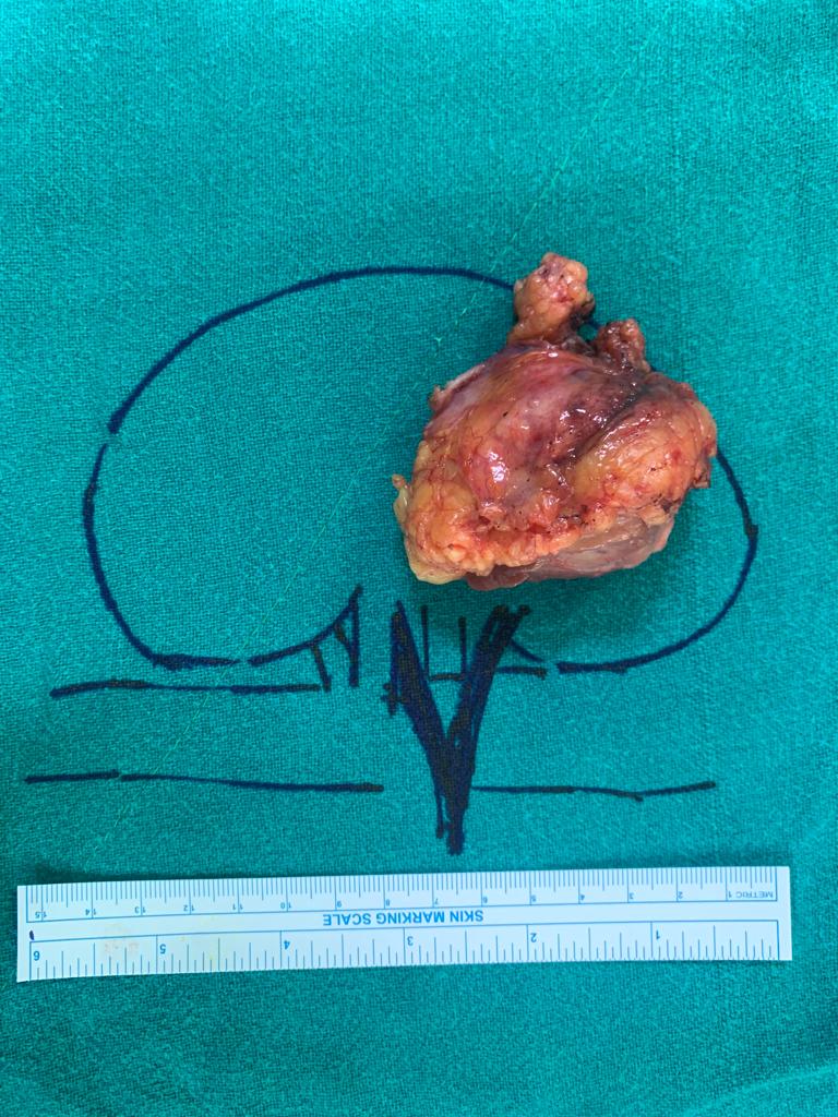 #Robotic Assisted Partial #Nephrectomy (#RAPN) for #Kidney #Tumors to completely remove the #cancer tissue and preserve the rest of the kidney.
#kidney #kidneycancer #kidneytumor #renalcancer #renaltumor #RAPN #roboticsurgery