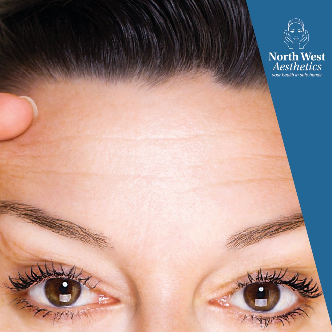 #ForeheadWrinkles deepen with age. #AntiWrinkleInjections prevent the development of new or existing lines, for a more #youthful appearance. Call 01942 909 003 to book your treatment at #NorthWestAesthetics.