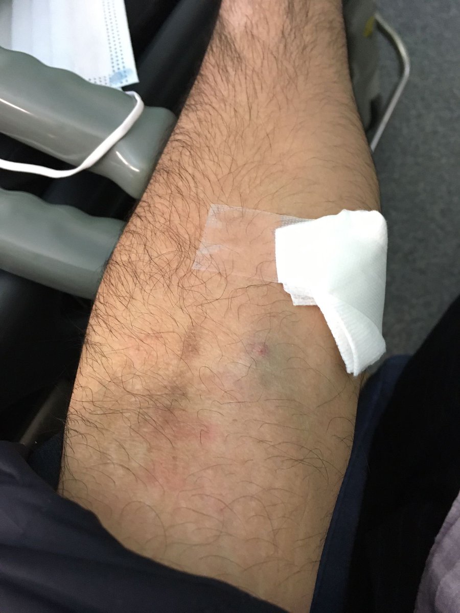 Heart attack later, I think I need some make up? Any advice? 😳 : 4 days later the marks are still there.