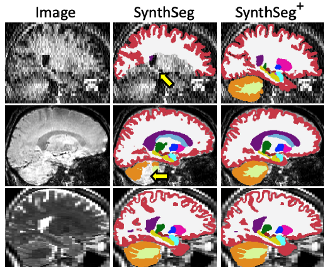 Juan Eugenio Iglesias (@juaneugenioigl1) on Twitter photo We have improved our publicly available tool "SynthSeg" to segment clinical brain MRI scans of any orientation, resolution and contrast. SynthSeg+ is much more robust than its predecesor. It is freely available on <a href="/FreeSurferMRI/">FreeSurfer</a> and works out of the box. Work with <a href="/sdas617/">Sudeshna Das, PhD</a> et al. We have improved our publicly available tool "SynthSeg" to segment clinical brain MRI scans of any orientation, resolution and contrast. SynthSeg+ is much more robust than its predecesor. It is freely available on <a href="/FreeSurferMRI/">FreeSurfer</a> and works out of the box. Work with <a href="/sdas617/">Sudeshna Das, PhD</a> et al.