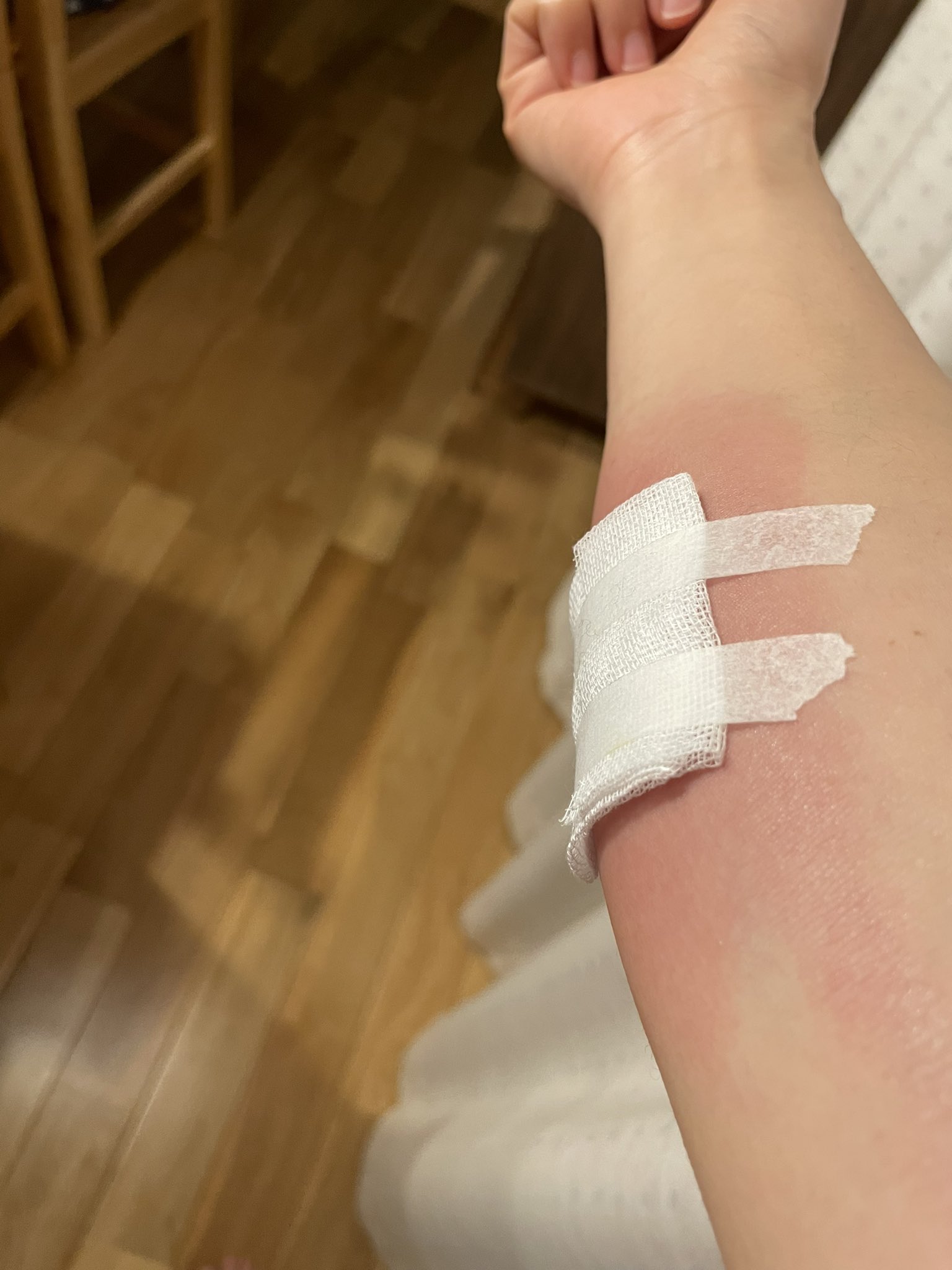 いわしピクニックのしいちゃんです 昨日刺されたブヨさま こんなに腫れちゃった ブヨに刺されたらすぐに水で洗って ジフェンヒドラミンの入っているお薬をぬればいいそう これからの時期 気をつけてね フリース着てたのになぁ ブヨさまお