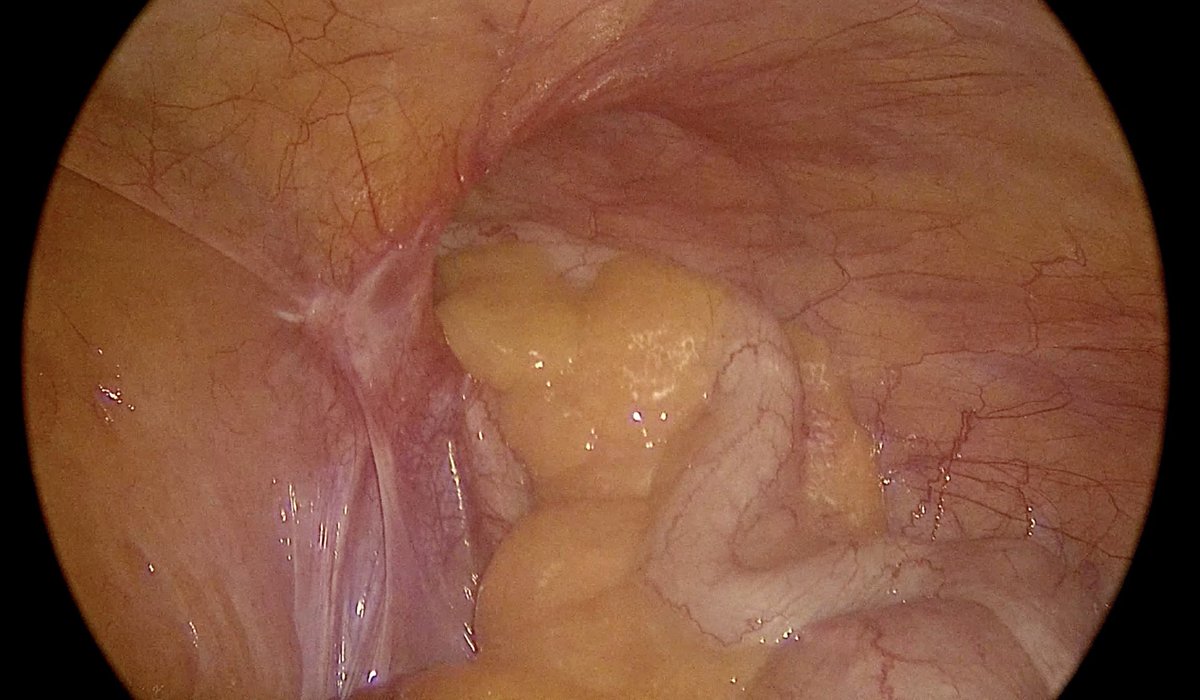 IFballesteros's tweet photo. Les comparto esta bonita imagen! Hernia inguinal derecha con contenido apéndice cecal!!! Se acuerdan cómo se le llama??? https://t.co/Tsz7WSeT4w