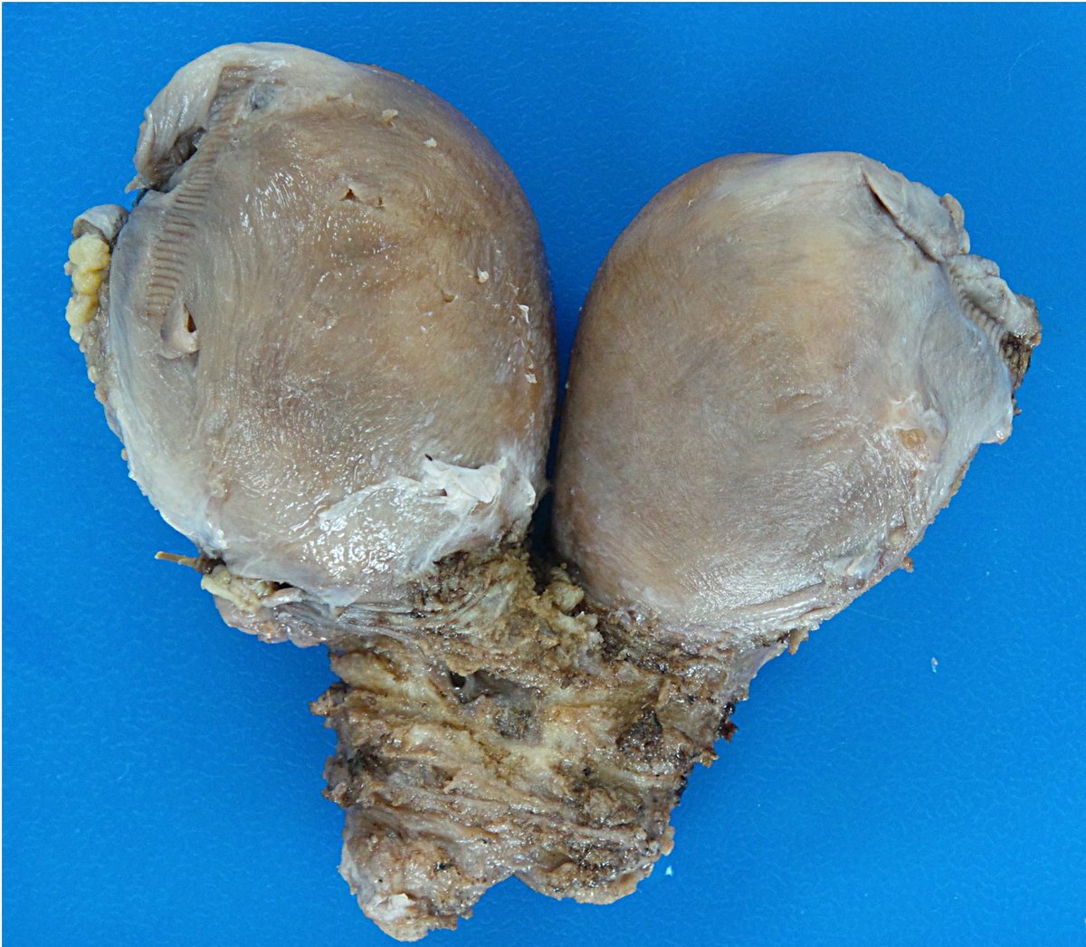 dianapath1's tweet photo. Fusión defect Müllerian duct: UTERUS BICORNUATE BICOLLIS #grossognosis #GinPath #GyO #Ginecology #Pathology #PathTwitter #pathologists https://t.co/kxhtojEv2i