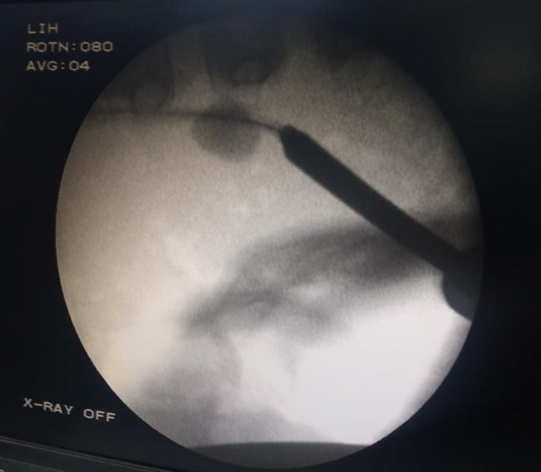 dravinashsingh's tweet photo. Horseshoe Kidney in a child.
mPCNL ( 16 Fr ) total clearance on table and used antegrade 6 Fr FT as Ureteric Stent till bladder and coming out through perc access.
Discharged PO day 2 after removing the stent ( just pulling it from outside) no suture .
#mPCNL #pcnl https://t.co/JXloCyrBMB