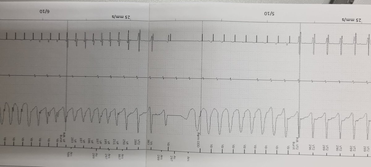 EP_BGM1's tweet photo. Several inappropriate ICD therapies (ATP) inducing VT / VF with eventually effective schock. Problem caused by an intermittent undersensing of the atrial lead. Peri-incisional (post-CABG), RA flutter, today 2:1 conduction, has been ablated. @BSC_EU_Heart @BSCCardiology https://t.co/QD2O7bFLOf