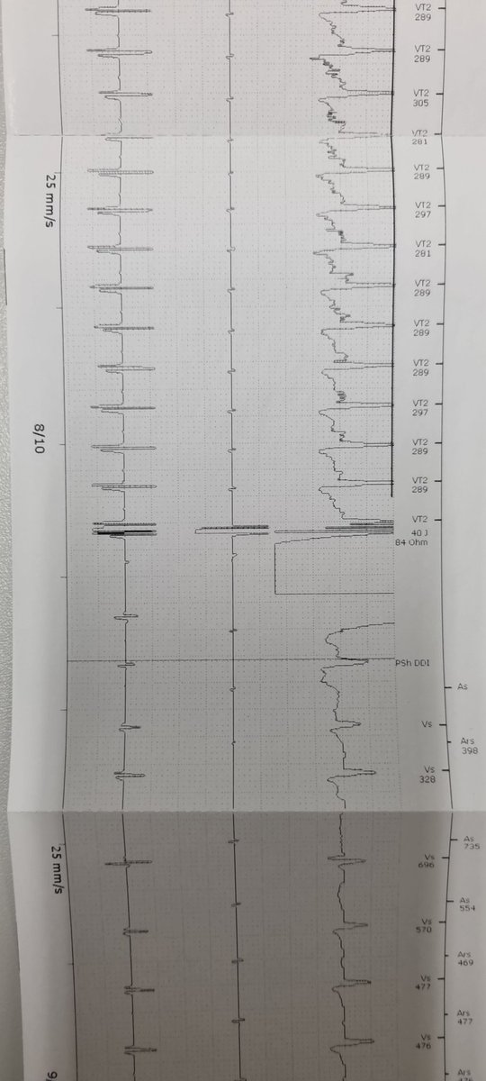 EP_BGM1's tweet photo. Several inappropriate ICD therapies (ATP) inducing VT / VF with eventually effective schock. Problem caused by an intermittent undersensing of the atrial lead. Peri-incisional (post-CABG), RA flutter, today 2:1 conduction, has been ablated. @BSC_EU_Heart @BSCCardiology https://t.co/QD2O7bFLOf