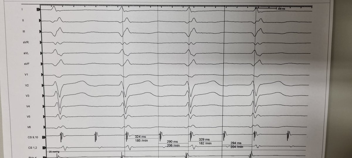 EP_BGM1's tweet photo. Several inappropriate ICD therapies (ATP) inducing VT / VF with eventually effective schock. Problem caused by an intermittent undersensing of the atrial lead. Peri-incisional (post-CABG), RA flutter, today 2:1 conduction, has been ablated. @BSC_EU_Heart @BSCCardiology https://t.co/QD2O7bFLOf