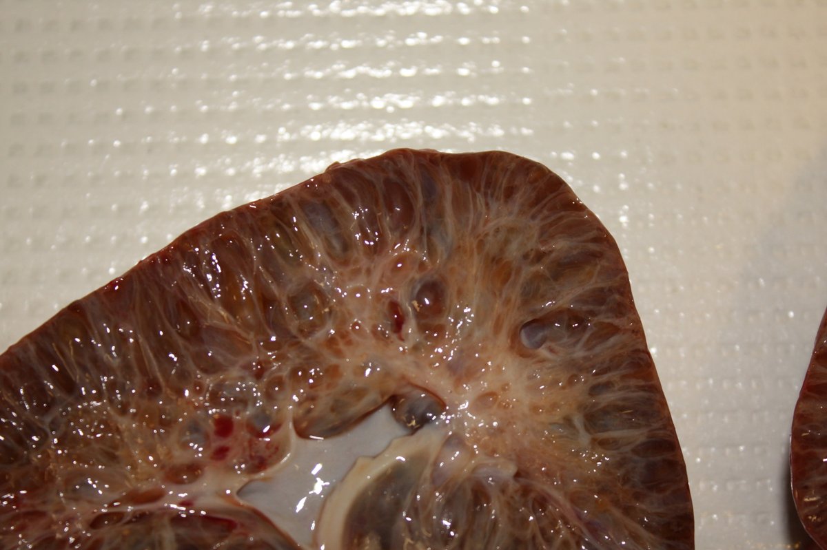 Nicole_Arva_MD's tweet photo. ARPKD can also be diagnosed on macroscopic examination, showing radially elongated dilated tubules. I added some pictures from our collection. #pedipath #pathtwitter #GUpath #pathology #pathologists https://t.co/doqXG8Uuhu