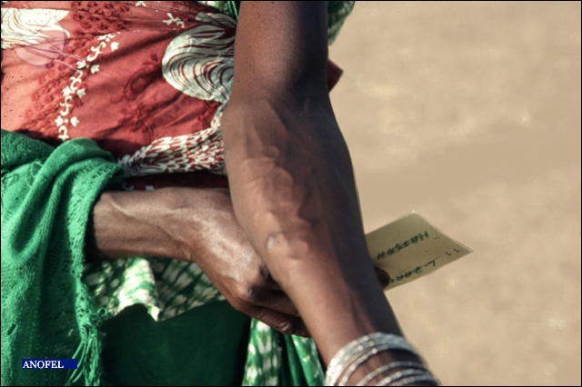 EAnofel's tweet photo. 🪱 Picture of the day: Guinea worm disease (or dracunculiasis) is caused by the roundworm Dracunculus medinensis. This parasite has one of the most amazing life cycle! The disease is now restricted to only a few african countries.
#thinkparasite #IDtwitter https://t.co/CwkZNkB6Qv https://t.co/ieGFCZ7e7k