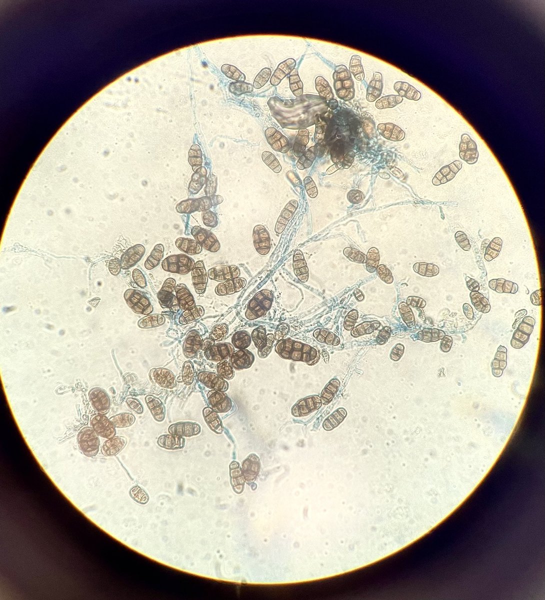 SCherianMicro's tweet photo. Monday Microbe! This dematiaceous mold is ubiquitous in the environment but has been known to cause subcutaneous phaeohyphomycosis. The distinctive appearance tells you it is… (choose your answer in poll below 👎) #MicroRounds #ClinMicroLab #PathTwitter https://t.co/7koWSUSGw9