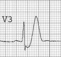 PragueICU's tweet photo. Can you recognize De Winter T wave on ECG? What does it indicate? Find it out in our ECG academy:
https://t.co/IHgv4Nji8D
@WondrMedical #EcgBot #CardioTwitter https://t.co/1FrqWCIDpS