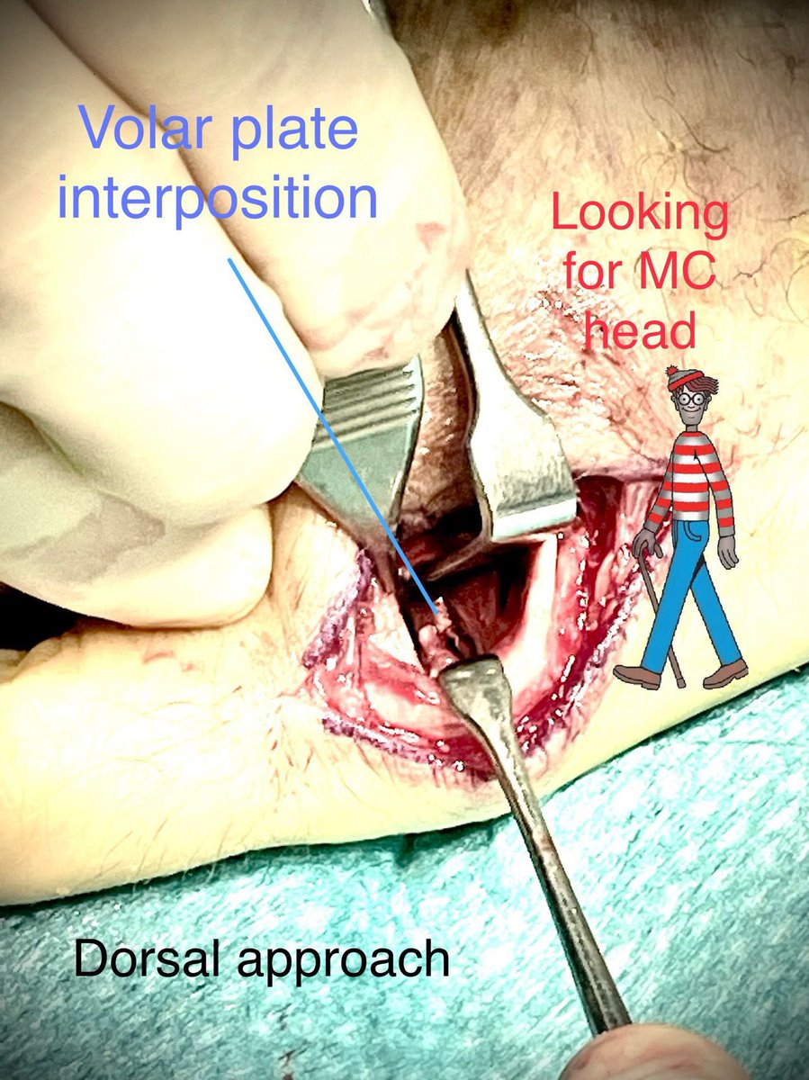 Optamos por abordaje dorsal radial al extensor del 5 dedo, encontrando la placa volar interpuesta. Tras reducción realizamos reconstrucción de bandeleta sagital.