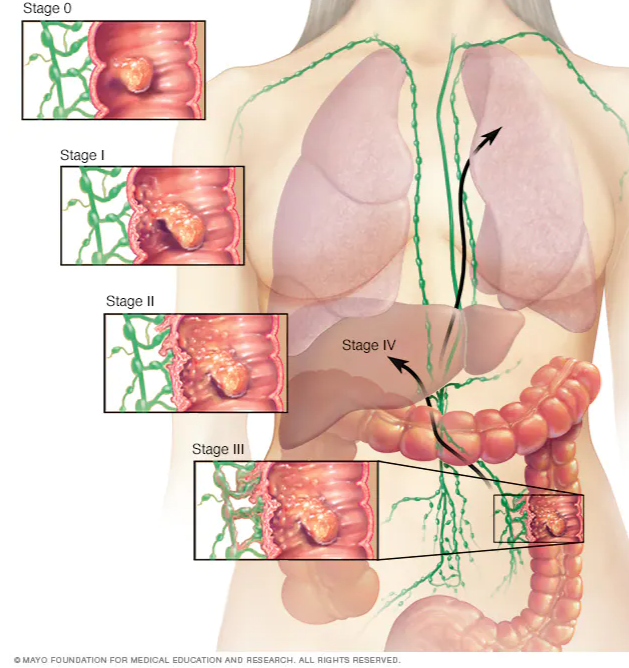3 стадия рака с метастазами