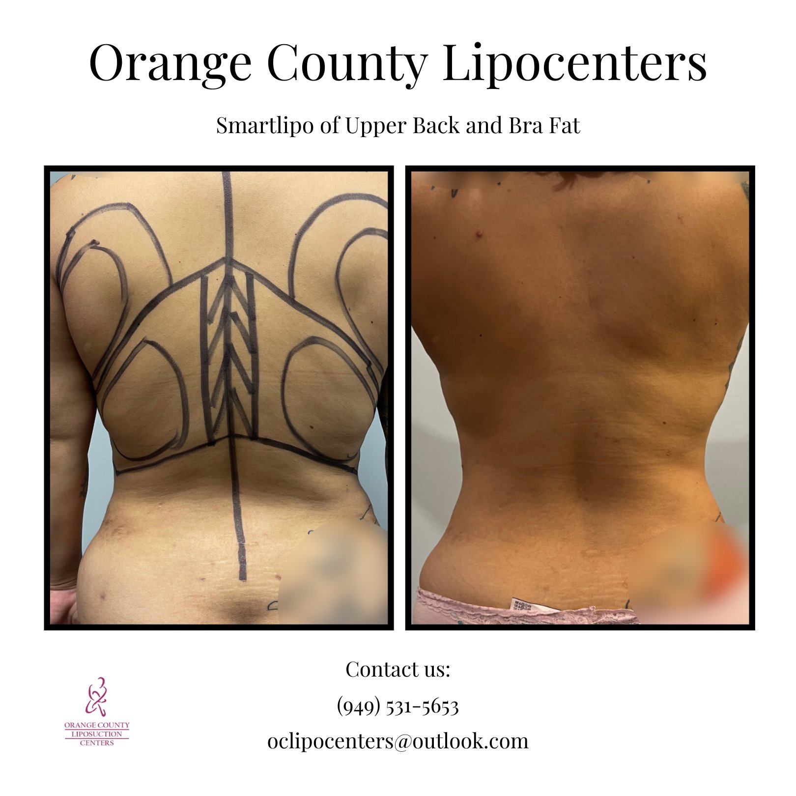 Los Angeles Liposuction Centers on X: Female patient is one year post op  from Smartlipo of her upper back and bra fat. Her results? A leaner,  curvier and more defined back. Who