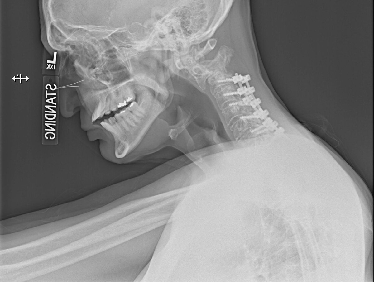 iyamah_abode's tweet photo. Stopping C2 vs. C3:

This gentleman presented to me with chin on chest deformity and grade 4 slip.  We were able to reduce this fuse him to occiput. 

What is your practice do you stop at C2 or C3?@DoctorQMd @gdebiase_md 

 #Deformity #spinesurgery #spine #neckpain #neurosurgery https://t.co/JDuC47b0tw