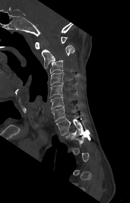 iyamah_abode's tweet photo. Stopping C2 vs. C3:

This gentleman presented to me with chin on chest deformity and grade 4 slip.  We were able to reduce this fuse him to occiput. 

What is your practice do you stop at C2 or C3?@DoctorQMd @gdebiase_md 

 #Deformity #spinesurgery #spine #neckpain #neurosurgery https://t.co/JDuC47b0tw