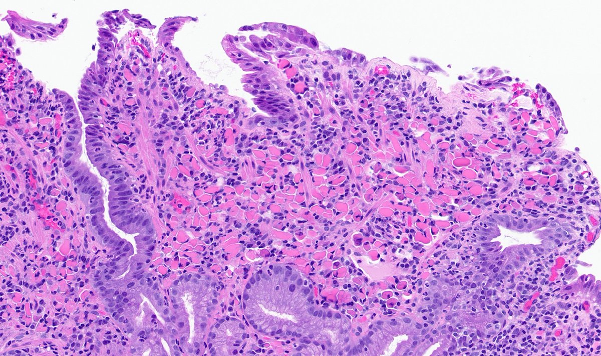 Cardia biopsy in a patient with ___ infection. *For bonus points: ✅Name the esoteric gastritis 🔬Name the pink cells