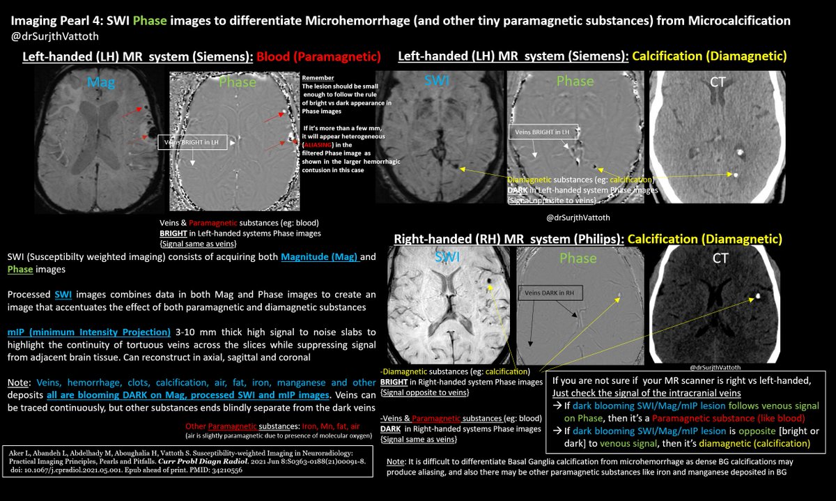 drSurjthVattoth's tweet photo. Imaging Pearl 4: Phase images of SWI MRI to differentiate Paramagnetic (eg:microhemorrhage) and Diamagnetic (microcalcification) lesions

Boils down to seeing if lesion FOLLOWS/is OPPOSITE to the bright or dark color of veins on Lt/Rt handed MR systems

Read our SWI article also https://t.co/qy3U2RsswW