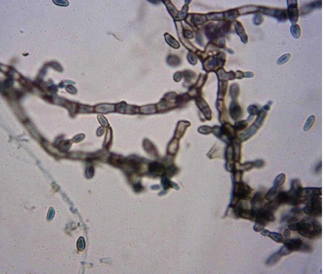 IUIDfellowship's tweet photo. #idboardreview A kid from Brazil w/ dark spots on palm x1mo now converged to salt &amp; pepper macule. septate, dematiaceous hyphae &amp; yeast-like cells w/ spores. Culture w/moist, shiny, rough &amp; black colony. #IDtwitter #dermtwitter #meded https://t.co/H3KIx0j65E