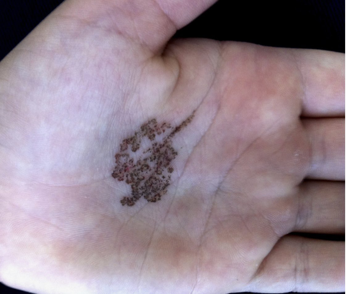 IUIDfellowship's tweet photo. #idboardreview A kid from Brazil w/ dark spots on palm x1mo now converged to salt &amp; pepper macule. septate, dematiaceous hyphae &amp; yeast-like cells w/ spores. Culture w/moist, shiny, rough &amp; black colony. #IDtwitter #dermtwitter #meded https://t.co/H3KIx0j65E
