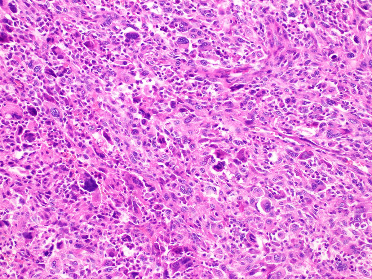 #BST when you retest filed cases of ‘undifferentiated pleomorphic sarcomas’ you find surprises Male 65 with soft tissue mass in the back