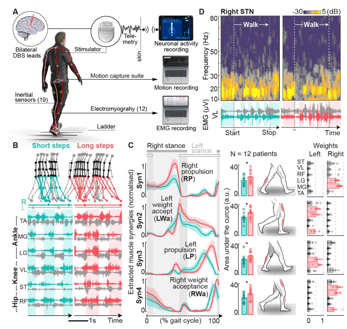 neumann_wj's tweet image. 🤯🧨🦾🦿🚶‍♀️Wow, this paper covers everything that you can with regard to subthalamic LFP, brain signal decoding and gait in #Parkinsons patients with #DBS. Check out the preprint by @YohannThenaisie and Kyuhwa Lees from @EdMoraud s group:
medrxiv.org/content/10.110…