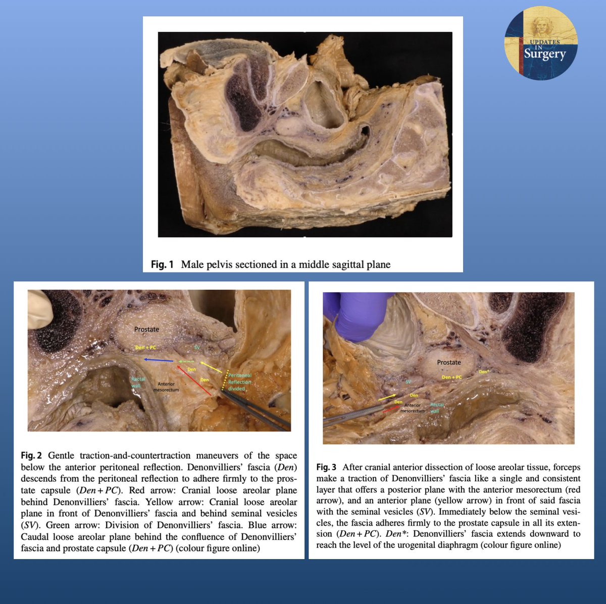 UpdatesSurgery's tweet photo. Anterior dissection of the rectum in the male pelvis represents one of the most complex phases of total meso-rectal excision.

Full article https://t.co/skc4gtrKPC https://t.co/JwBBydgUKz