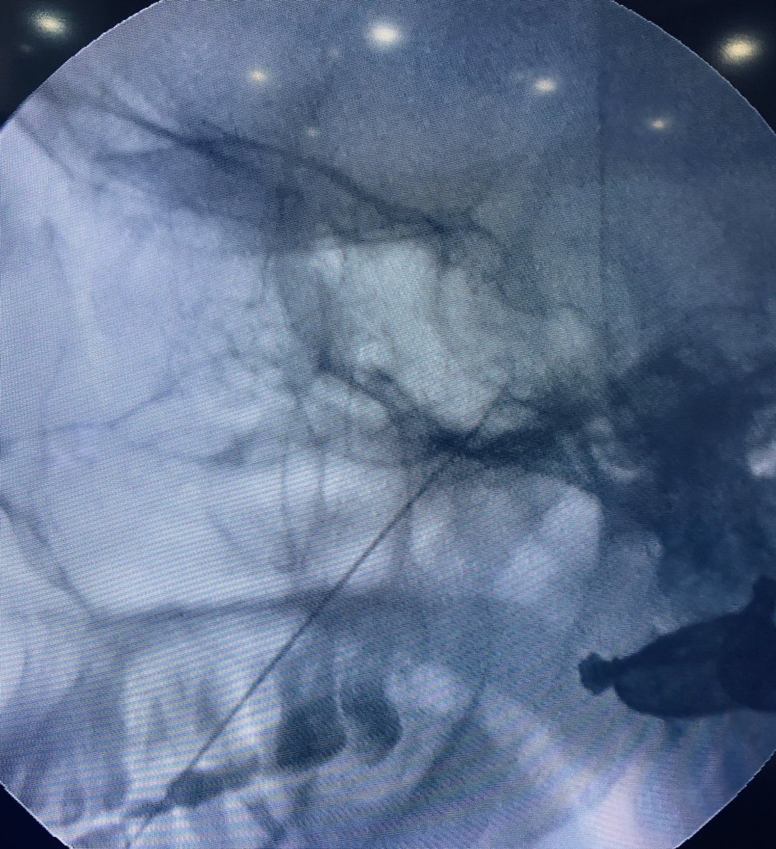 tariqtramboo's tweet image. Radiofrequency procedure for #Trigeminal Neuralgia done just now at #Reliefpainservice kashmir. 
No sedation given. Pulsed RFA for 300 sec, before conventional RFA desensitises the ganglion for heated ablation (RFA). Patient did not require any sedation during the procedure.