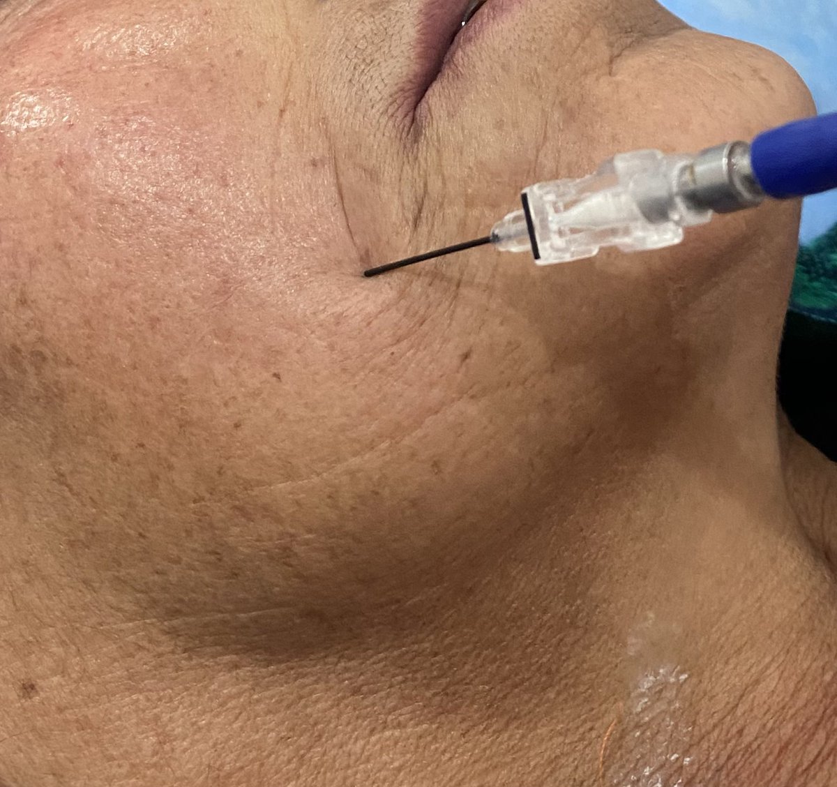 tariqtramboo's tweet image. Radiofrequency procedure for #Trigeminal Neuralgia done just now at #Reliefpainservice kashmir. 
No sedation given. Pulsed RFA for 300 sec, before conventional RFA desensitises the ganglion for heated ablation (RFA). Patient did not require any sedation during the procedure.