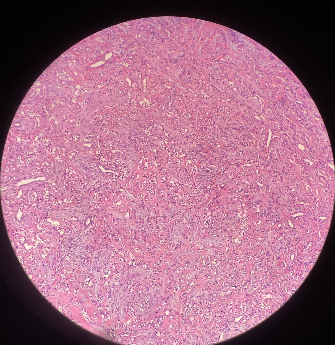 wala9252's tweet photo. Any idea what’s going on here? '
26 year old woman with focal heterogenous enhancing mass at left base of the tongue (2x2.3x1.3cm) complaining of sore throat and dysphasia. https://t.co/sOQhHxCvnq