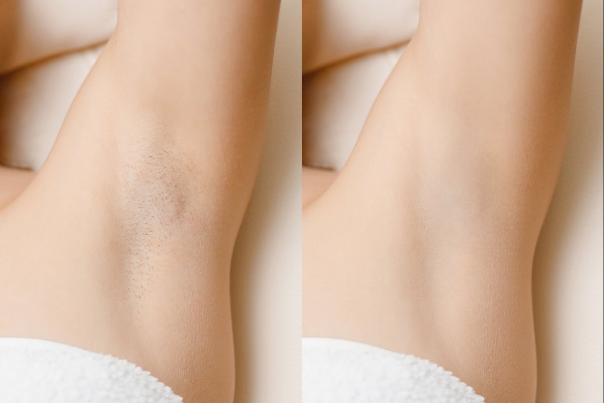 CryoRefresh's tweet photo. Just look at these results!

Our laser hair removal is super fast, safe and pain-free!

Contact us to book your first session!

#laserhairremoval https://t.co/HwfupmzOJC
