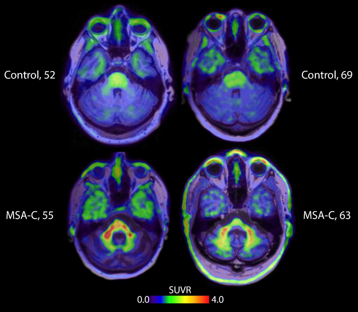 Researcher Presents First Non-Invasive Images of Alpha-Synuclein in the Brain ow.ly/b2SB50IlPKh <a href="/RSNA/">RSNA</a> <a href="/RadiologyACR/">American College of Radiology</a> <a href="/ACRRFS/">ACR RFS</a> <a href="/ACRYPS/">ACR YPS</a> <a href="/TheASNR/">The American Society of Neuroradiology</a> <a href="/JNeuroradiology/">Journal of Neuroradiology</a> <a href="/neurology_live/">NeurologyLive®</a> <a href="/OHSUNeurorad/">OHSU Neuroradiology</a> @USCneurorads <a href="/OskarHansson9/">Oskar Hansson</a> <a href="/lunduniversity/">Lund University</a> <a href="/ARRS_Radiology/">ARRS</a>