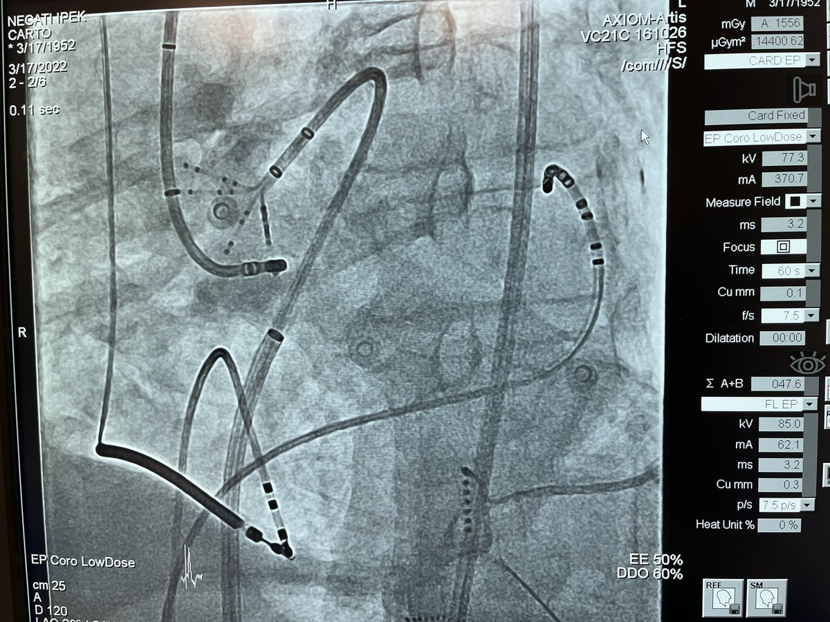 Timuçin Altın (@timucin_alt) on Twitter photo Periaortic VT ablation after 3 previous attempts (1 complicated with tamponade). 2 VT morphologies induced. With midisthmus beneath RCC. Sinus rhythm during RF 50 W.#EPeeps <a href="/baskovski/">Emir Baskovski</a> <a href="/busrakuru_17/">Büşra Kuru Görgülü</a> <a href="/seeenaaay/">şenay</a> <a href="/ziya_er/">M.Ziya Er</a> <a href="/elifoykucelik/">Elif Öykü Tataroğlu</a> <a href="/akyurek_omer/">omer akyurek,MD</a> Periaortic VT ablation after 3 previous attempts (1 complicated with tamponade). 2 VT morphologies induced. With midisthmus beneath RCC. Sinus rhythm during RF 50 W.#EPeeps <a href="/baskovski/">Emir Baskovski</a> <a href="/busrakuru_17/">Büşra Kuru Görgülü</a> <a href="/seeenaaay/">şenay</a> <a href="/ziya_er/">M.Ziya Er</a> <a href="/elifoykucelik/">Elif Öykü Tataroğlu</a> <a href="/akyurek_omer/">omer akyurek,MD</a>