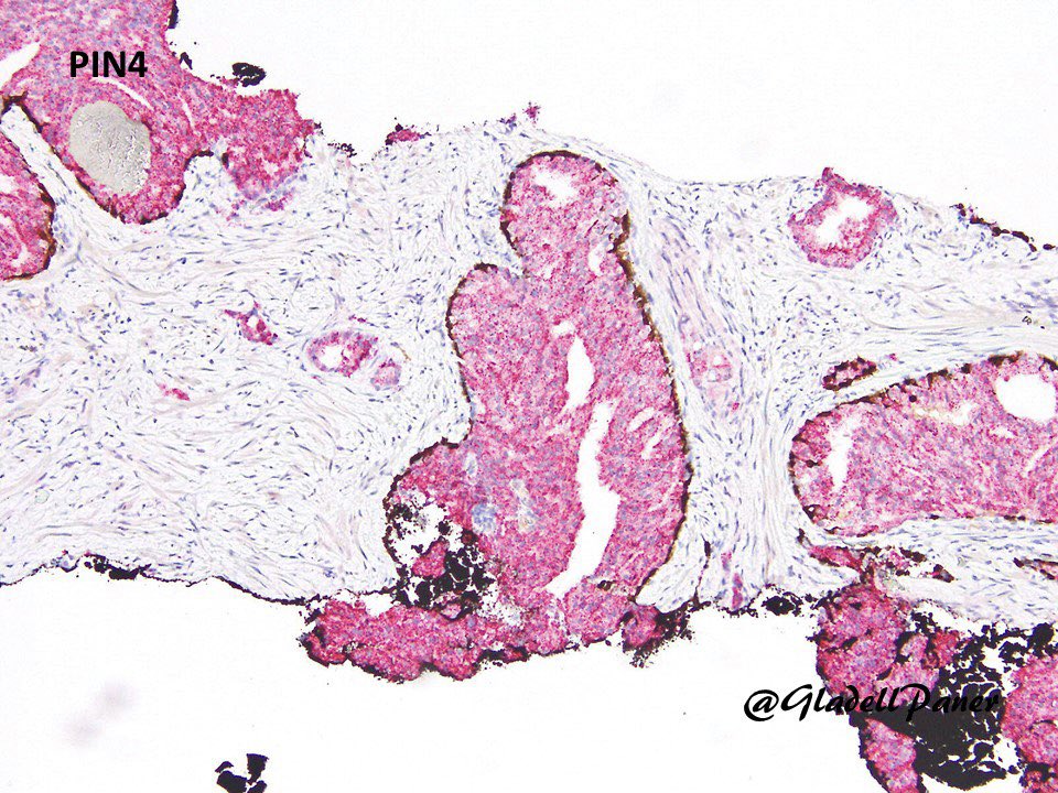 GladellPaner's tweet photo. Caption this #prostate cancer with its Gleason grade. 🤔
#GUPath #GrayZonePath
Spoiler - 3 grade confounders in IDC-P, ?poorly-formed glands and perineural invasion. https://t.co/ZARyoDPFvr