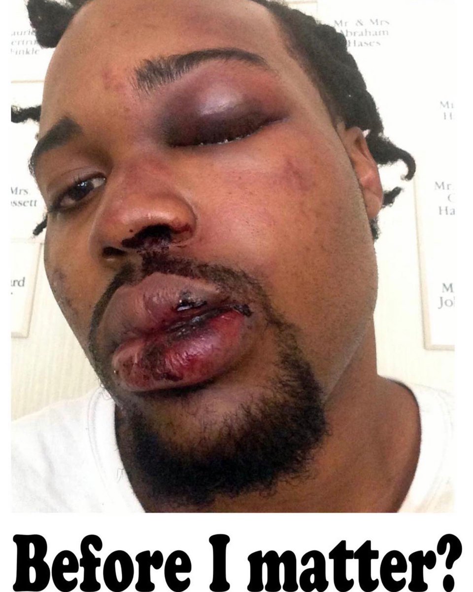 Vote4Francois's tweet photo. @MiamiPD issued a statement firing M. Fernandez after a video surfaced from 2020 showing the officer using excessive force. But won’t take any actions on who smashed my face after @MiamiHEAT title Win in 2013 @DwyaneWade @KingJames @MickyArison @MiamiMayor #Doublestandard #Bias https://t.co/C3hJGnSOAP