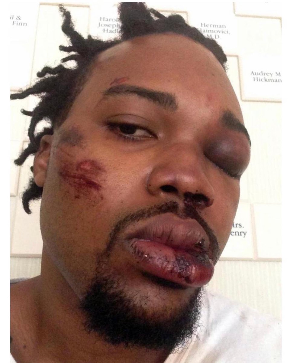 Vote4Francois's tweet photo. @MiamiPD issued a statement firing M. Fernandez after a video surfaced from 2020 showing the officer using excessive force. But won’t take any actions on who smashed my face after @MiamiHEAT title Win in 2013 @DwyaneWade @KingJames @MickyArison @MiamiMayor #Doublestandard #Bias https://t.co/C3hJGnSOAP