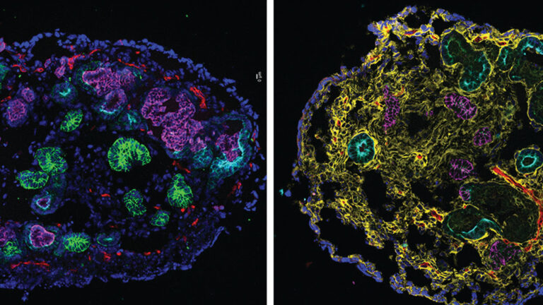HaubenCraig's tweet image. .@harvardmed’s Navin Gupta recently led a study dealing with significant #Biotech advancements. The team of researchers utilized #organoids to locate the particular point when kidney damage becomes irreparable. #KidneyDisease #HealthTech
statnews.com/2022/03/02/org…
