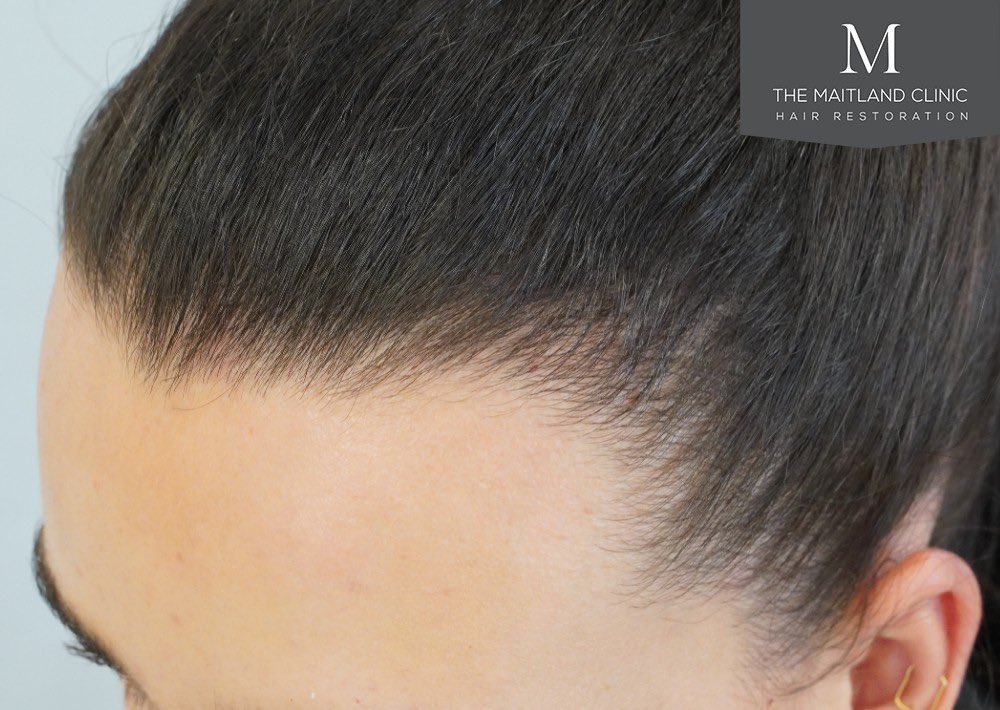 New gallery post! Female hairline lowering on our results page. themaitlandclinic.com/results/904-gr… #hairtransplantuk