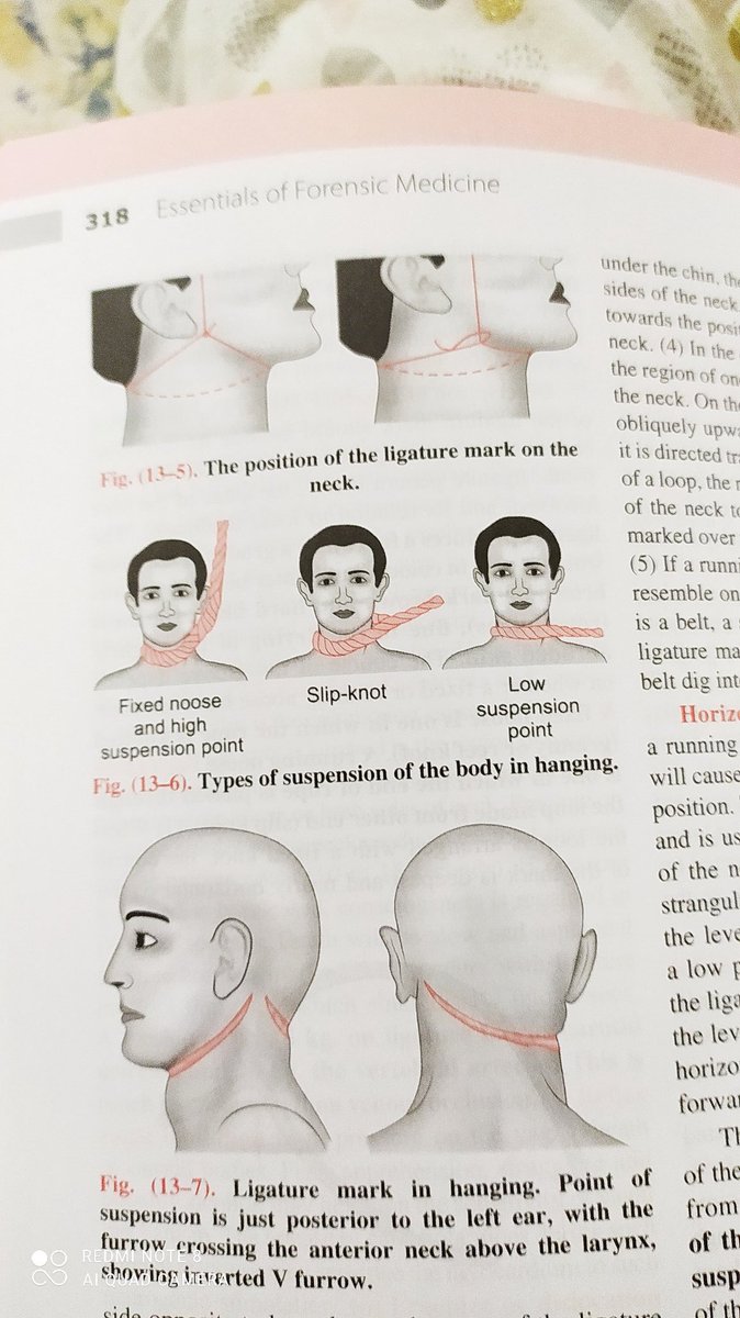 SelfMusingSushi's tweet photo. Kindly compare the condition of ligature mark on SSR's neck.
Source: Textbook of forensic medicine by Narayan Reddy
We want 302
Now nobody can Stop us
Day641 Immortal Sushant
#JusticeForSushantSinghRajput
United Against Bollywood
#BoycottBollywood https://t.co/6jtZcZtq9T