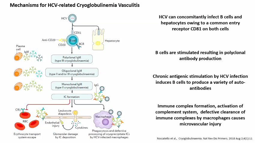 ladydrseuss's tweet photo. Quick visual review of the pathogenesis of cryoglobulinemic vasculitis. @aishaikh
⚡️ Abarrent Ab production by B-cells
⚡️ Sustained antigenic stimulation
⚡️ Subsequent monoclonal/polyclonal activation of B-lymphocytes
⚡️ HCV🦠infects, induces B-cells ➡️ polyclonal Ab production https://t.co/2m754JUk4l