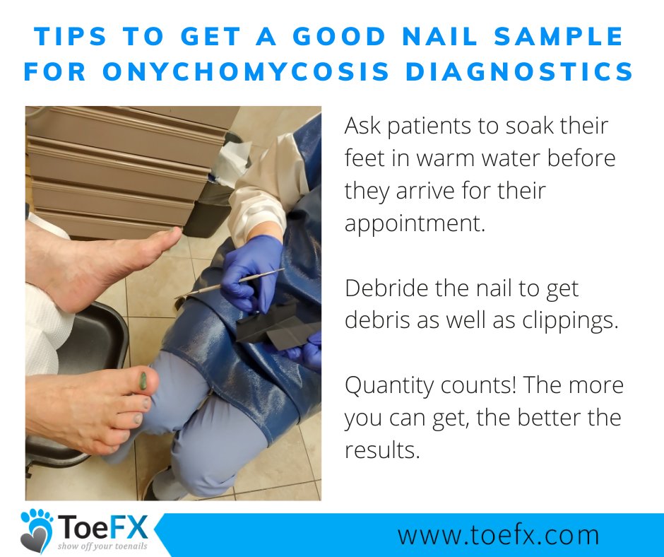 toe_fx's tweet photo. This week, we demonstrated how we take nail samples for lab testing. Here are our top tips for getting the best results!

 #ToeFX #toenailfungus #onychomycosis #fungus #chiropodist #podiatrist https://t.co/sQ8dkA4bD6